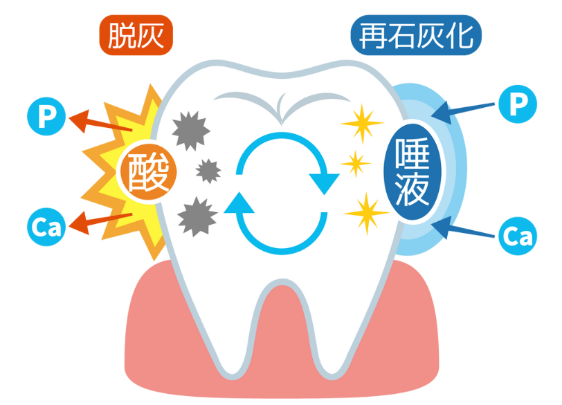 虫歯が進行する仕組み｜うめおか歯科