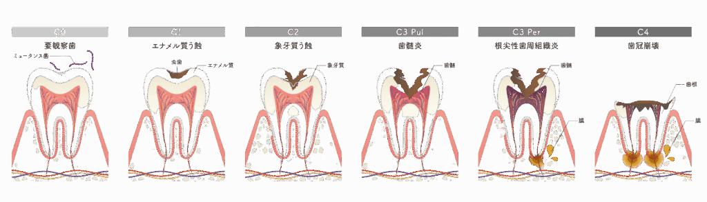 虫歯の進行｜うめおか歯科