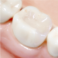 インレー｜うめおか歯科