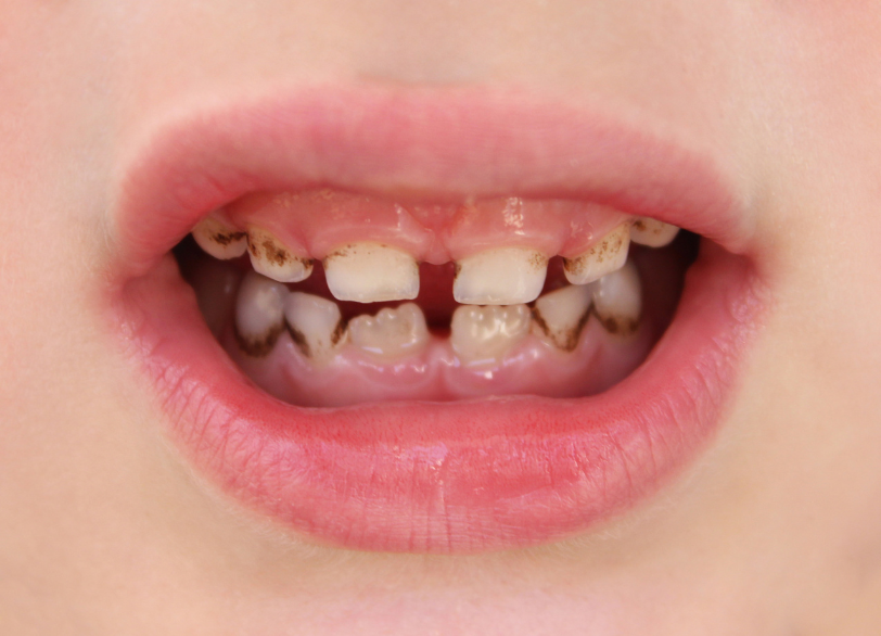 子どもの虫歯 特徴｜うめおか歯科