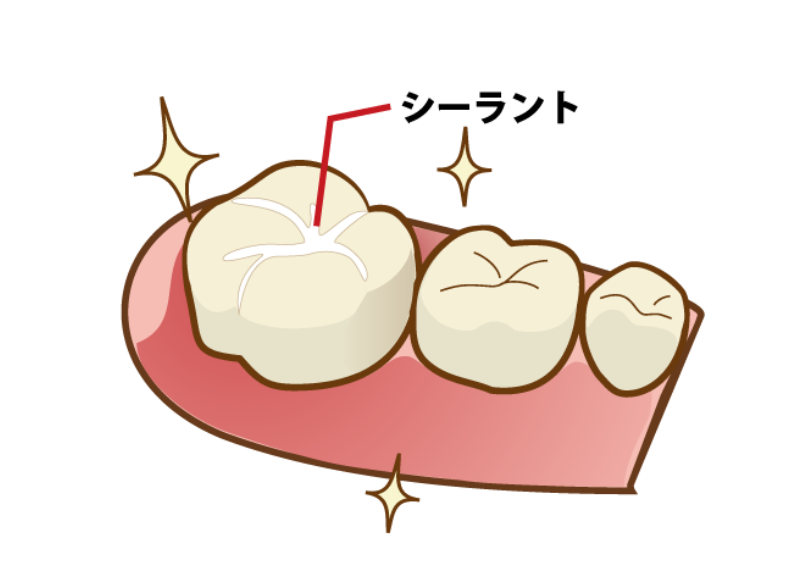 シーラント｜うめおか歯科