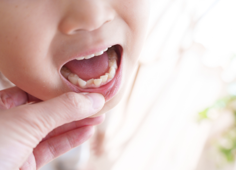 第1期治療｜うめおか歯科