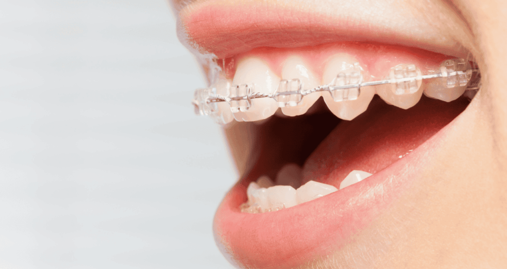 大人になってからの矯正治療｜うめおか歯科