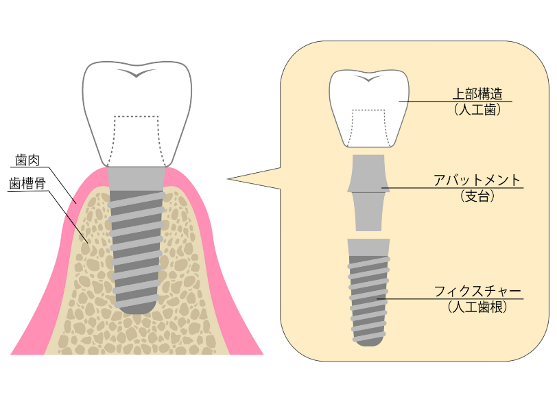 インプラントの構造｜うめおか歯科