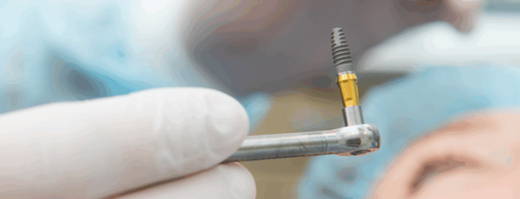 インプラント治療とは｜うめおか歯科