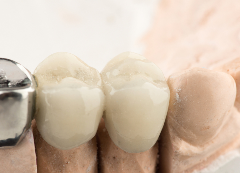 ブリッジ｜うめおか歯科