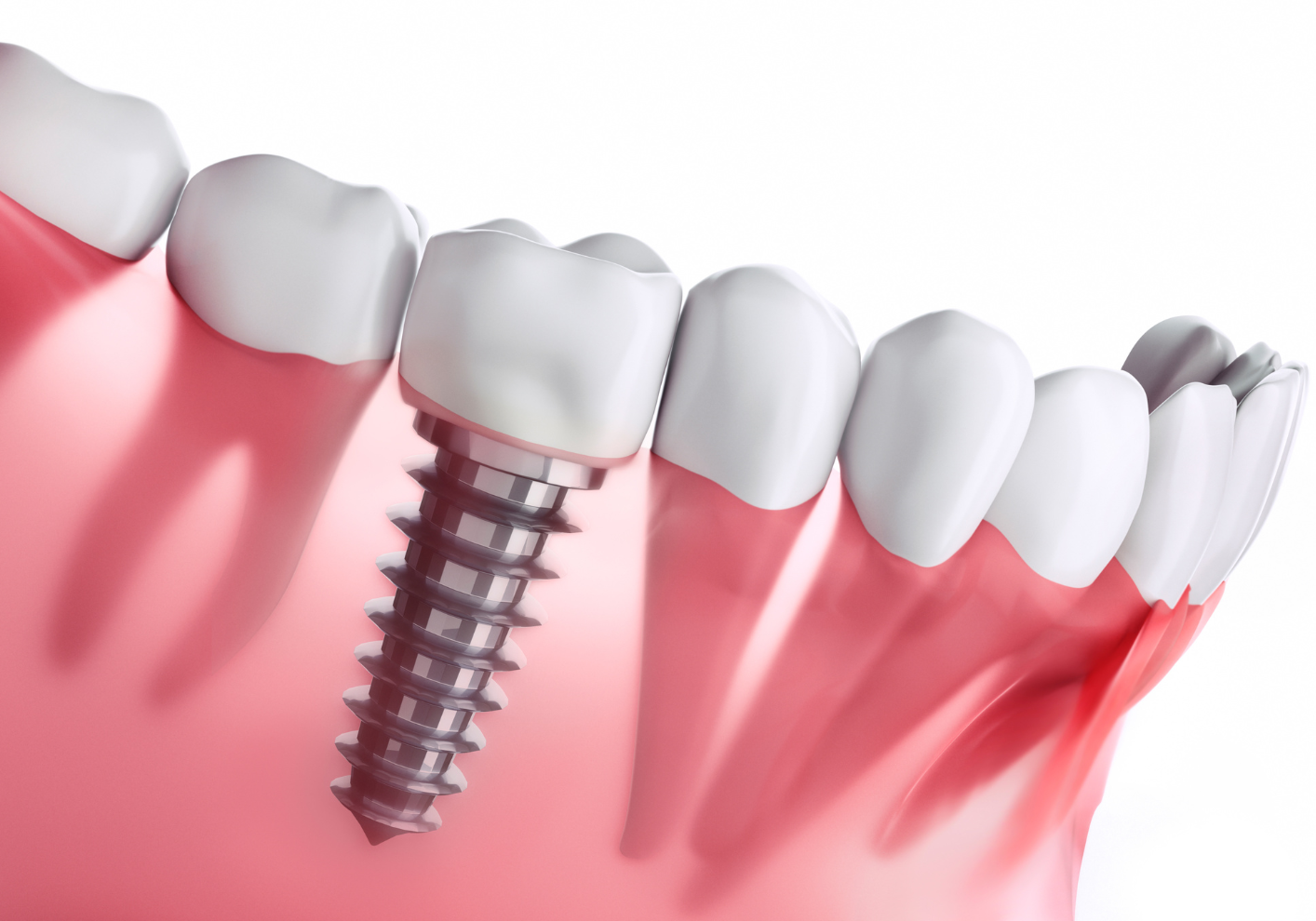 インプラント｜うめおか歯科