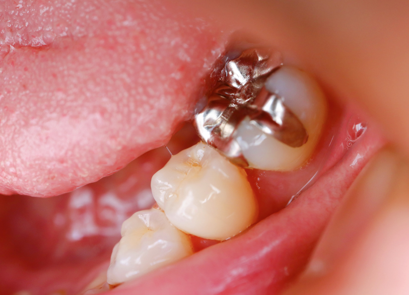 保険診療｜うめおか歯科