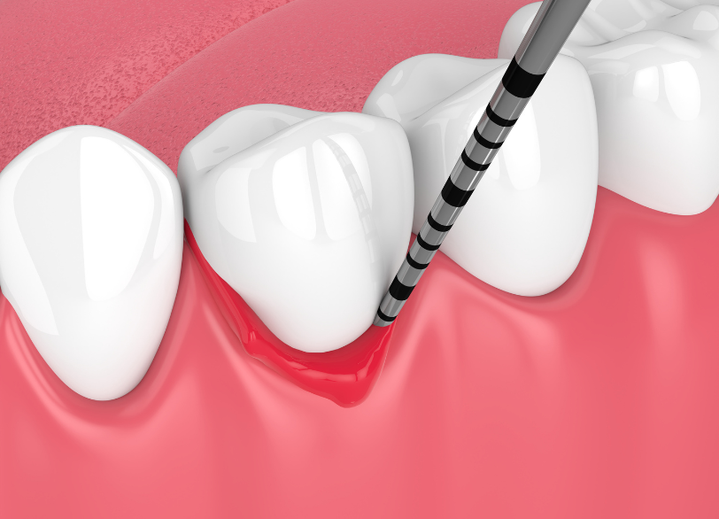 歯周病と全身の関わり｜うめおか歯科