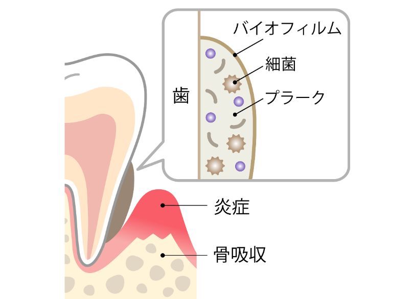 歯周病｜うめおか歯科