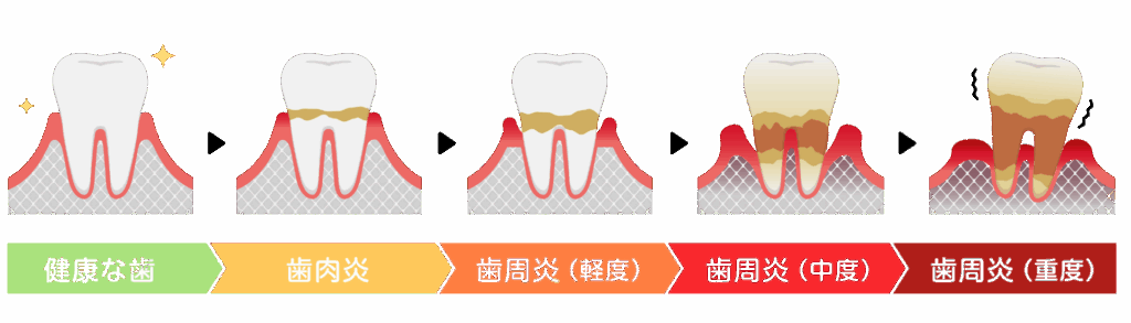 歯周病の進行｜うめおか歯科