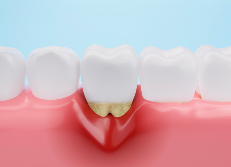 歯周病セルフチェック｜うめおか歯科