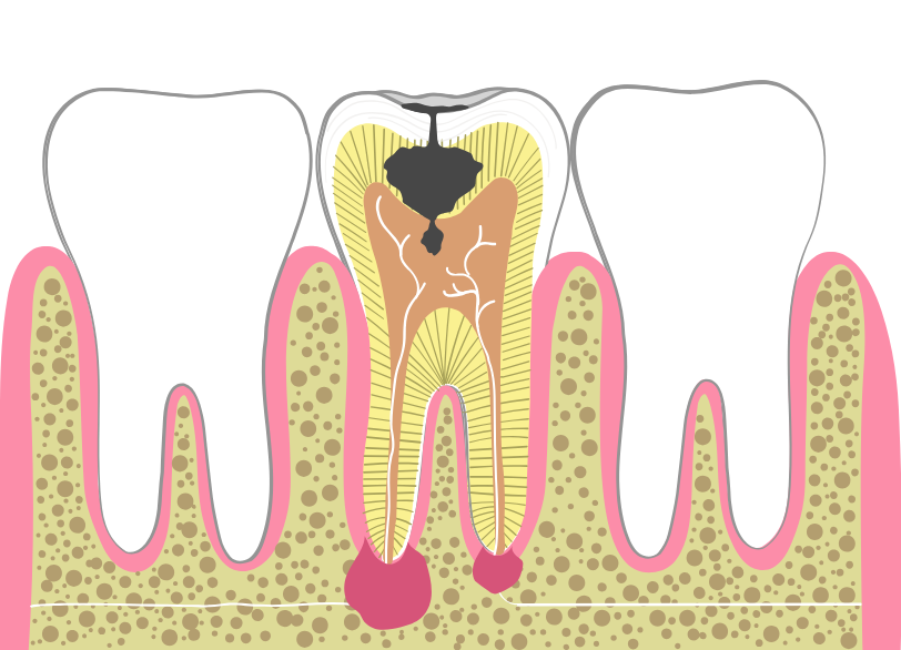 根管治療が必要なケース｜うめおか歯科