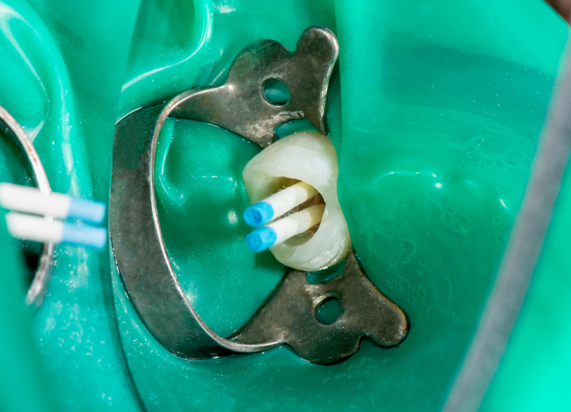 再感染を防ぐ根管充填｜うめおか歯科