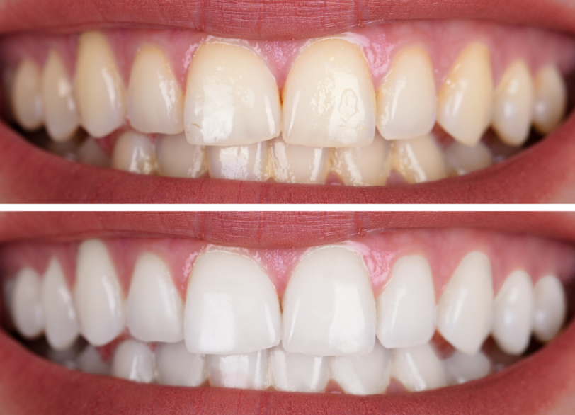 ホワイトニングの仕組み｜うめおか歯科