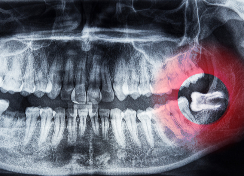 親知らずとは｜うめおか歯科