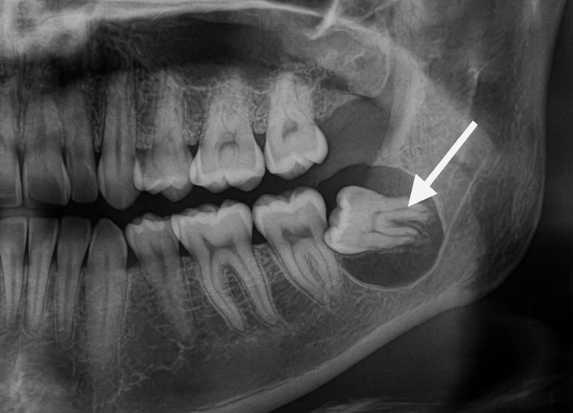嚢胞（のうほう）の形成｜うめおか歯科