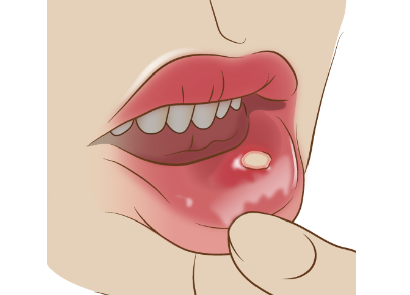 口腔粘膜疾患｜うめおか歯科