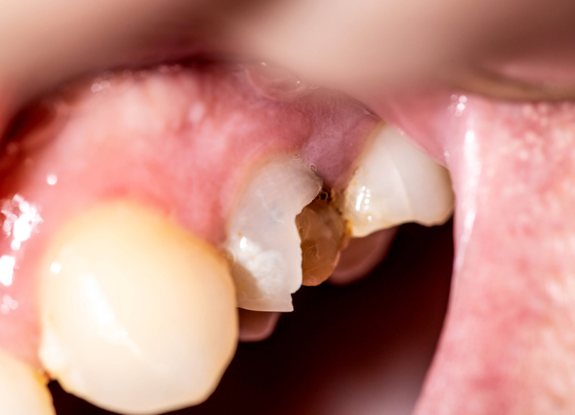 歯のケガ（外傷）｜うめおか歯科